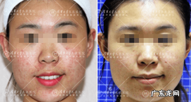 为什么果酸可以祛痘 果酸去痘痘