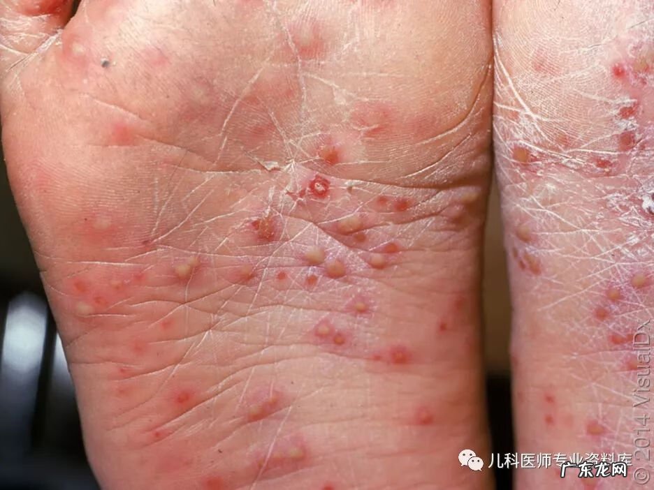 手足口病症状图片 手足口病的症状图片 初期