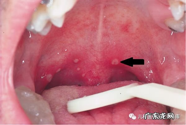 手足口病症状图片 手足口病的症状图片 初期