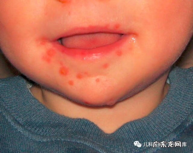 手足口病症状图片 手足口病的症状图片 初期