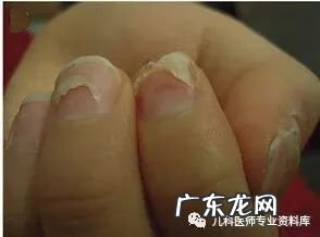 手足口病症状图片 手足口病的症状图片 初期