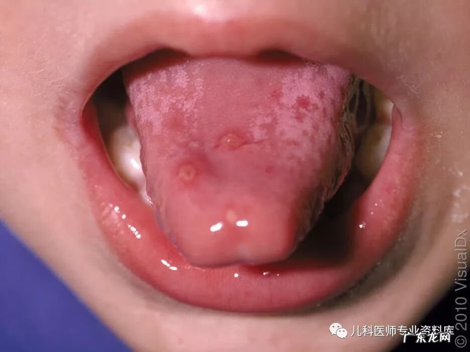 手足口病症状图片 手足口病的症状图片 初期