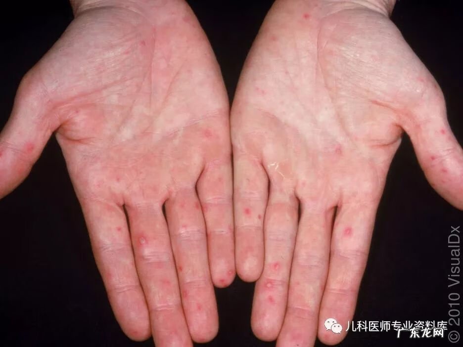 手足口病症状图片 手足口病的症状图片 初期