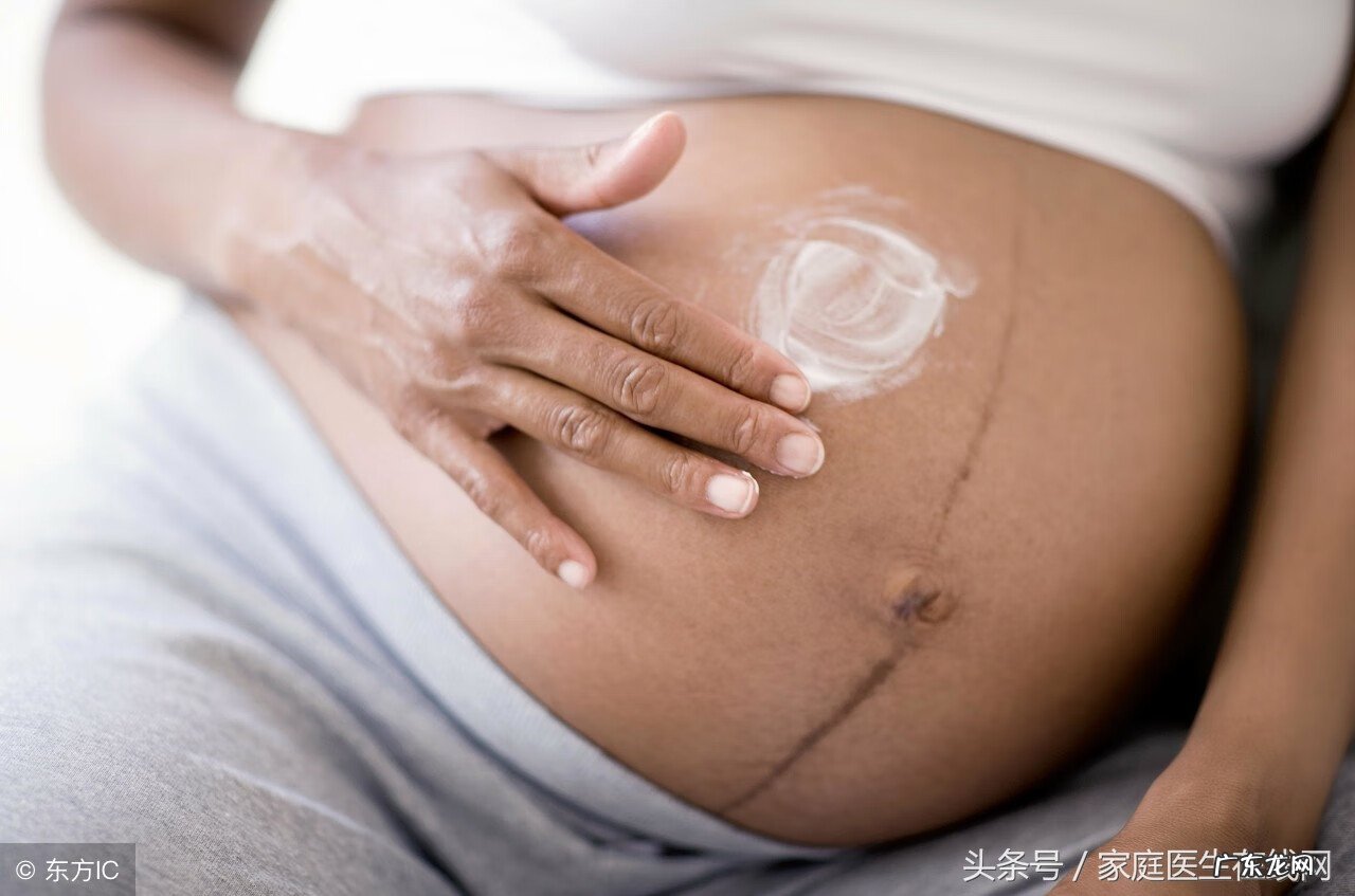 妊娠纹怎么可以消除 妊娠纹怎么才能去除