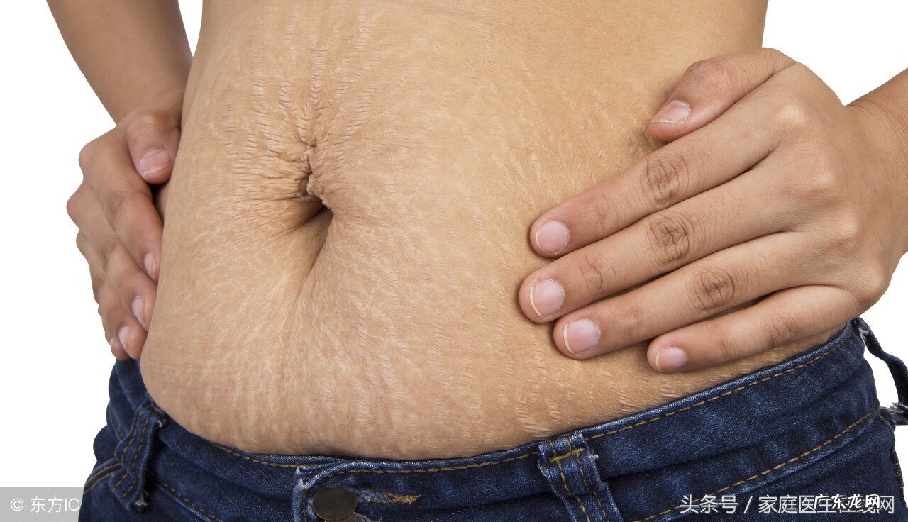 妊娠纹怎么可以消除 妊娠纹怎么才能去除