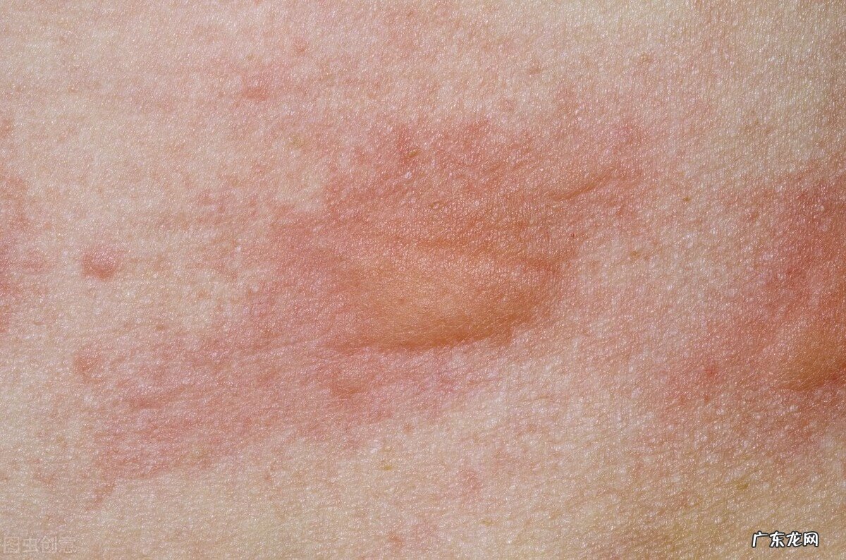 怎样才能彻底治愈慢性荨麻疹 如何治慢性荨麻疹