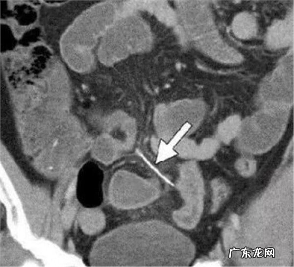 鱼刺卡住的感觉忽隐忽现 鱼刺卡住了怎么办?