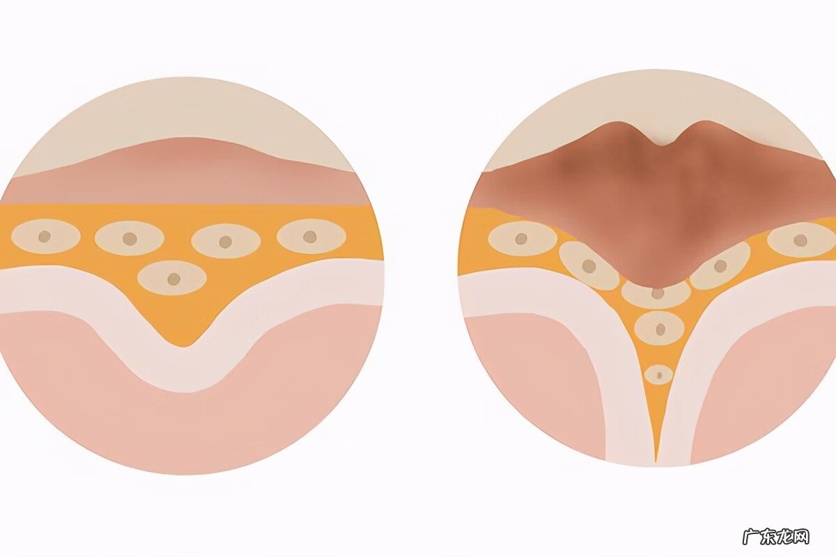 鸡眼是什么样子图片 鸡眼图片