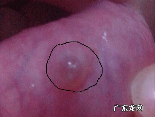 去水泡的方法 水泡怎么处理好得快