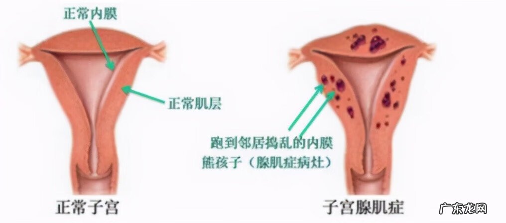 子宫腺肌症的早期症状 子宫腺肌症的症状有哪些
