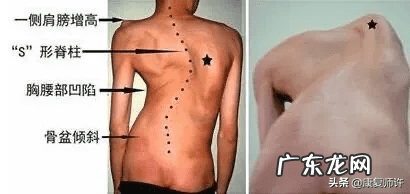 成人肋骨外翻有什么危害 肋骨外翻是怎么回事