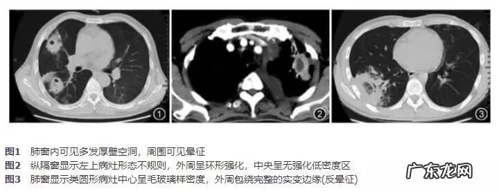 毛霉菌肺部感染 肺部毛霉菌感染