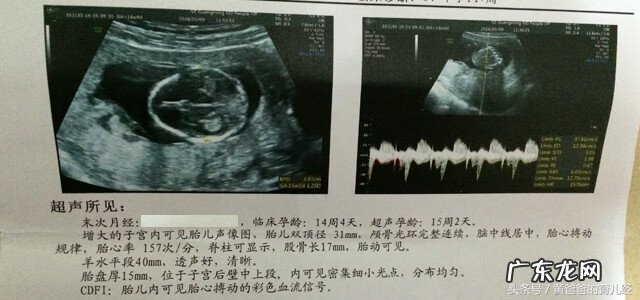 彩超怎么看胎儿性别 彩超看胎儿性别图解