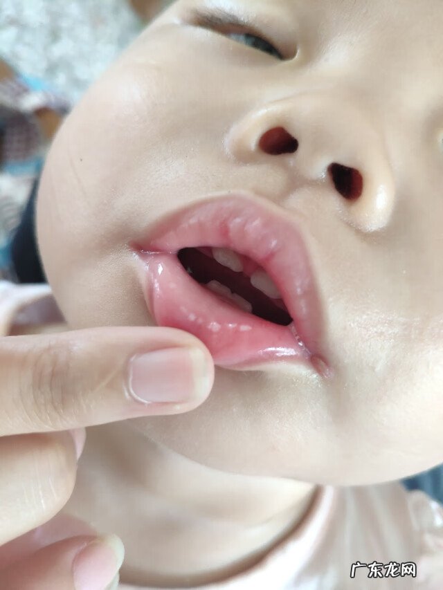 上嘴唇有白点颗粒状 嘴唇上有白点点是什么原因