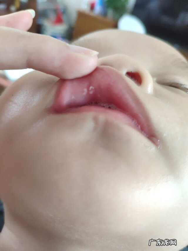 上嘴唇有白点颗粒状 嘴唇上有白点点是什么原因