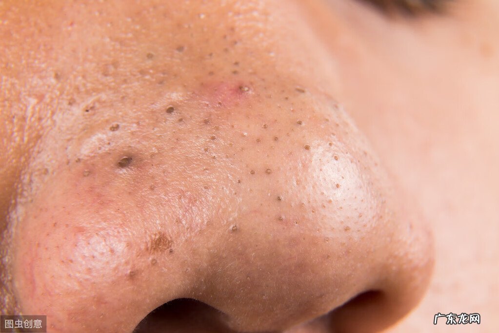 鼻子上有草莓鼻怎么办 是草莓鼻怎么办