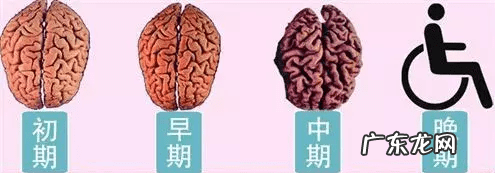 小脑萎缩严重吗 小脑萎缩是怎么引起的