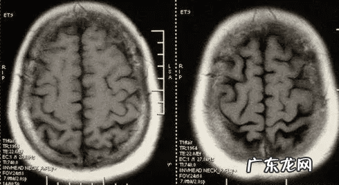 小脑萎缩严重吗 小脑萎缩是怎么引起的