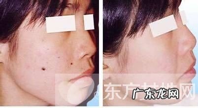 点痣需要注意什么事项 点痣后注意事项有哪些