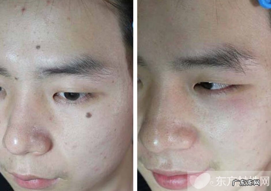 点痣需要注意什么事项 点痣后注意事项有哪些