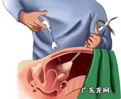 宫腹腔镜是什么意思 宫腹腔镜联合术
