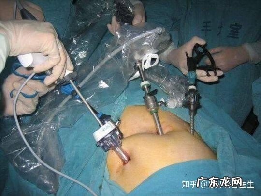 宫腹腔镜是什么意思 宫腹腔镜联合术