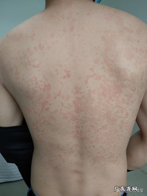 癣图片 汗癣图片