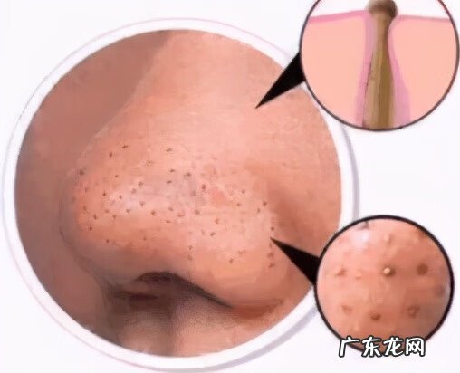 鼻子上的黑头怎么回事 鼻子上黑头多怎么去除