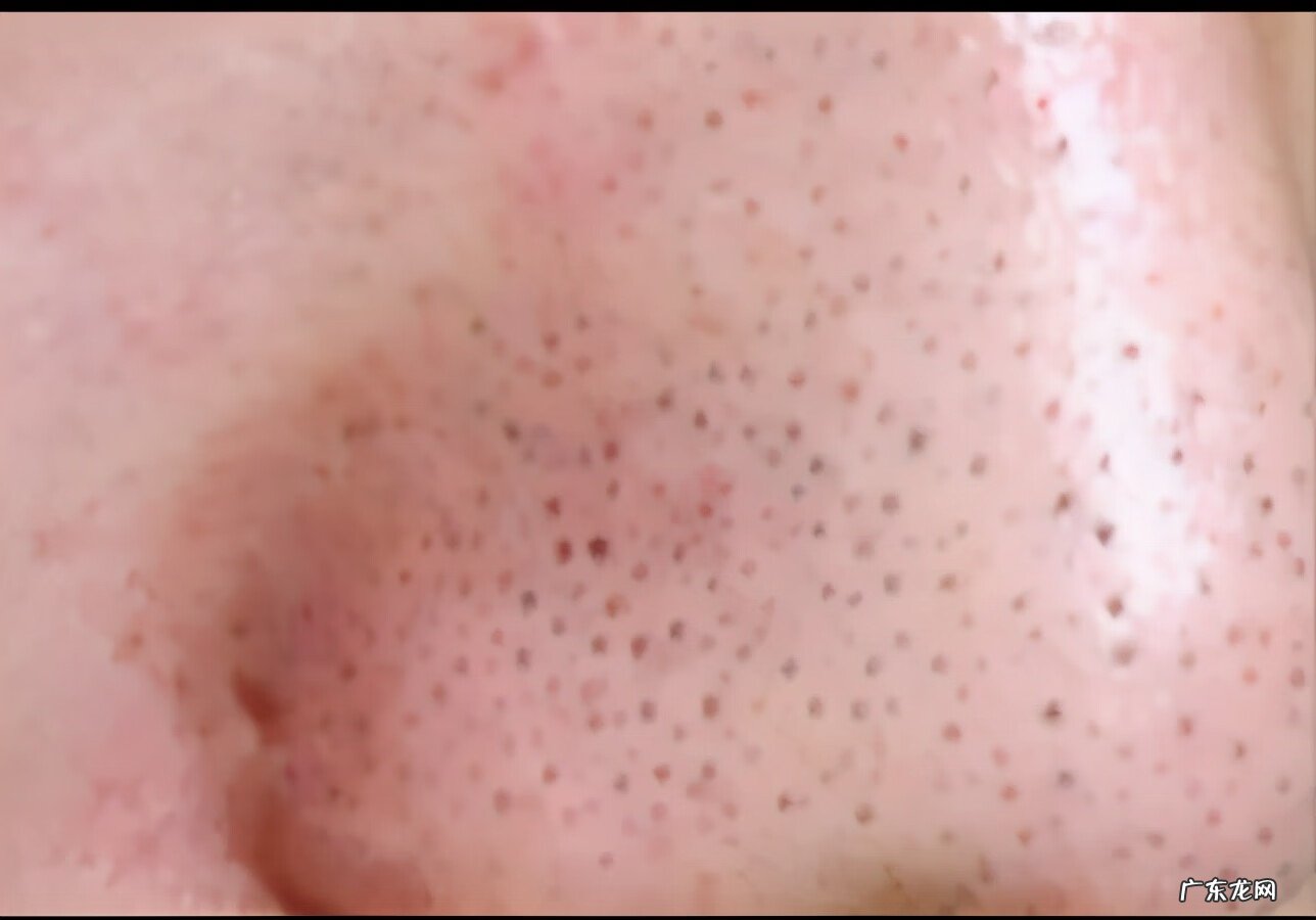 鼻子上的黑头怎么回事 鼻子上黑头多怎么去除