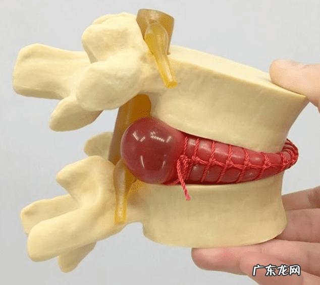 腰间盘突出怎么才能治好 腰间盘突出怎么根治方法