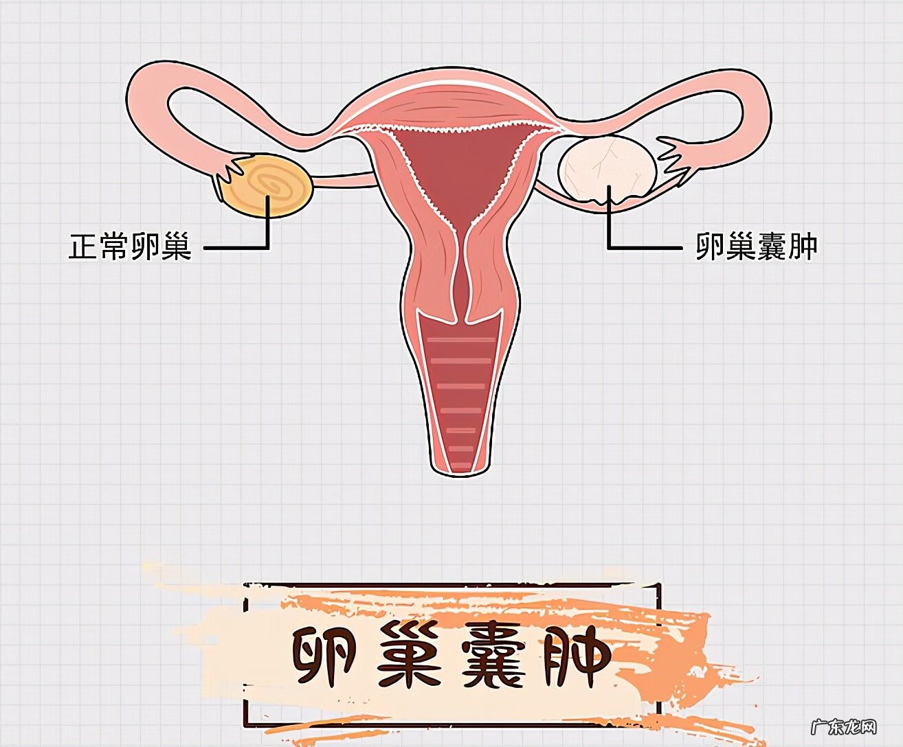 右侧卵巢囊肿什么意思 右侧卵巢囊肿什么导致的