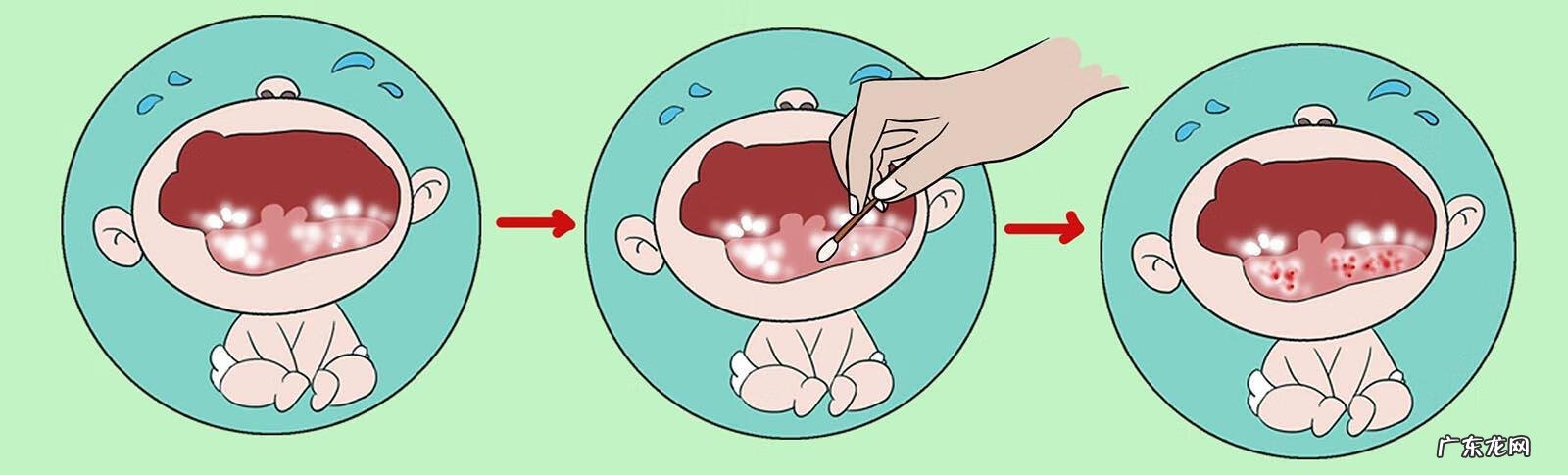 鹅口疮怎么才能治好 怎么治疗鹅口疮