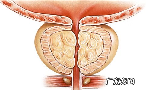尿结石止痛药哪个效果最好 尿结石的最佳治疗方法