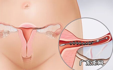 宫外孕最早多少天有症状 宫外孕多少天有症状?