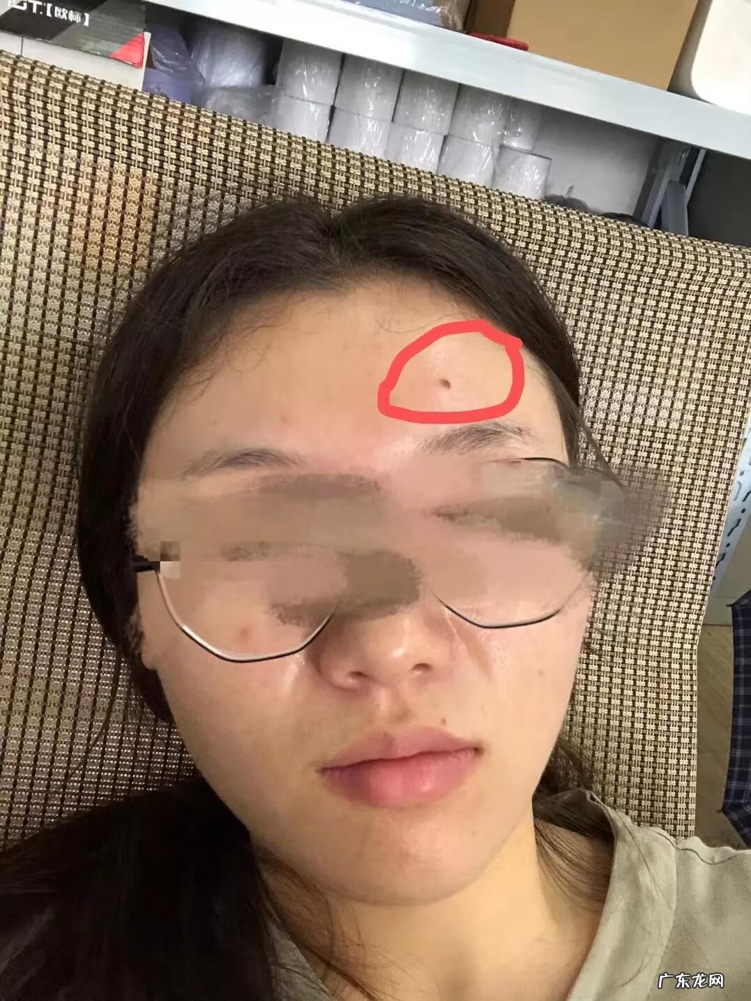 激光祛痘效果好吗 激光祛痘大概价格