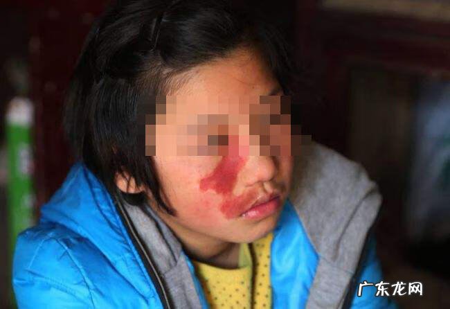 婴儿脸上有青色的印记 后背长青色印记