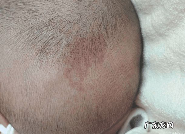 婴儿脸上有青色的印记 后背长青色印记