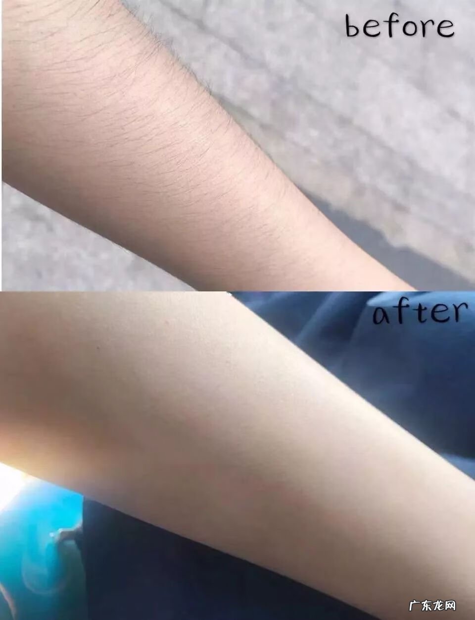 冰点脱毛属于激光吗 超冰激光脱毛