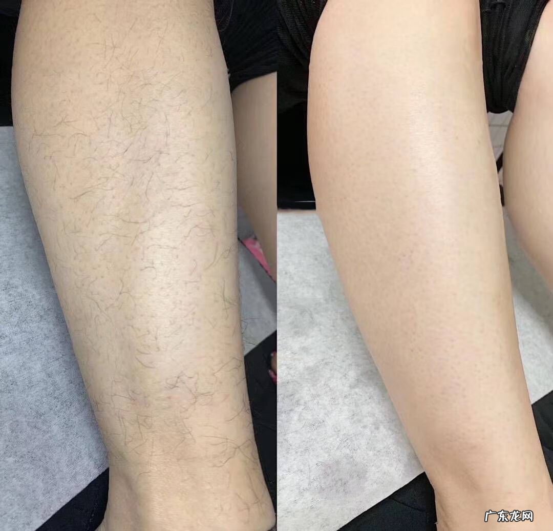 冰点脱毛属于激光吗 超冰激光脱毛