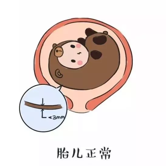 正常胎儿nt应该是多少 nt值多少为正常范围