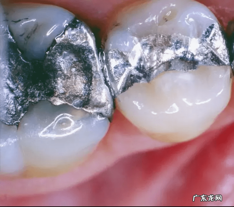 牙齿痛 吃什么药 牙齿疼吃什么药好得快