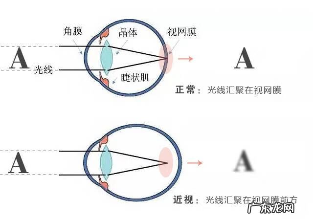 近视眼度数对照表 高度近视眼底病变