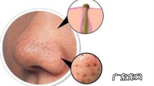 细盐去黑头 用粗盐去黑头