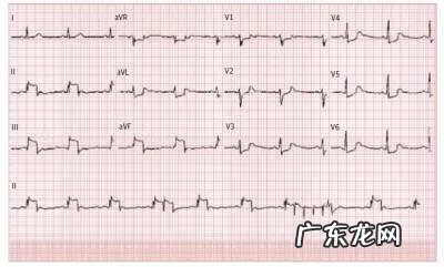 年轻人心电图异常是什么原因 心电图异常是什么原因