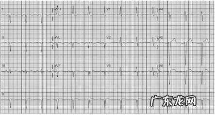 年轻人心电图异常是什么原因 心电图异常是什么原因