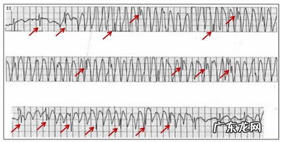 年轻人心电图异常是什么原因 心电图异常是什么原因