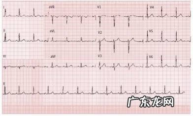 年轻人心电图异常是什么原因 心电图异常是什么原因