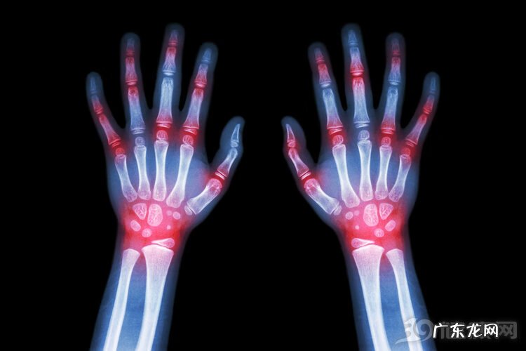 尿酸最新标准值是多少 尿酸正常值范围是多少?