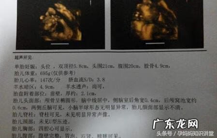 生儿子的四维彩超图片 双胞胎四维彩超的最佳时间