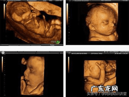 生儿子的四维彩超图片 双胞胎四维彩超的最佳时间